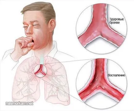 Soluții și nebulizatoare inhalatoare pentru medicamente pentru tuse