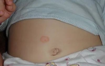 Roz herpesul zoster simptome, tratament si prevenire la om