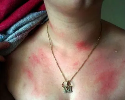 Simptomele alergice și fotografie la apă (alergie) Simptomele alergice și fotografie la apă