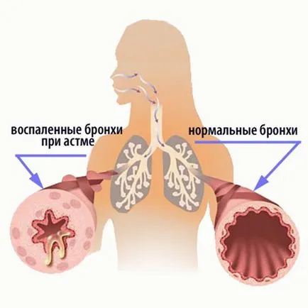 recenzii Singulair“, instrucțiuni de utilizare, preț