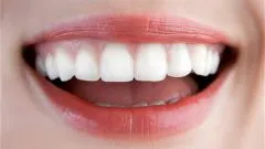 Cât de mult purta aparat dentar