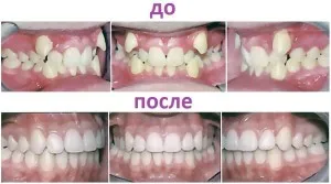Cum de a purta aparat dentar