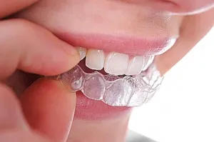 Cât de mult uzura aparat dentar - recomandări stomatologi