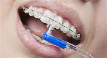 Cât timp ar trebui să poarte aparat dentar pentru a alinia dinții într-un adult, adolescent și copil
