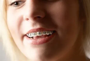 Cât timp ar trebui să poarte aparat dentar pentru a alinia dinții într-un adult, adolescent și copil