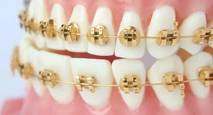 Cât timp ar trebui să poarte aparat dentar - purtarea acolade termeni (cât de mult) Cât timp ar trebui să poarte bretele - bretele poartă termene