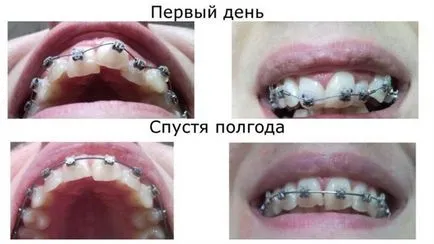Cât timp ar trebui să poarte aparat dentar pentru a alinia dinții într-un adult, adolescent și copil