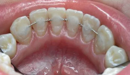 Cât timp ar trebui să poarte aparat dentar - corecție de temporizare (uzura) Cât timp ar trebui să poarte aparat dentar - de corecție a temporizării