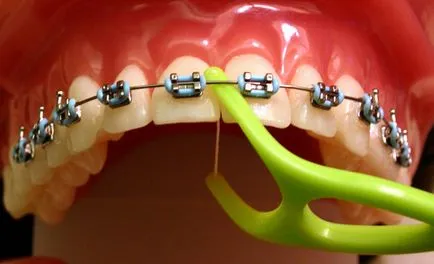 Cât timp ar trebui să poarte bretele răspunsuri la toate întrebările legate (cât de mult trebuie să poarte aparat dentar) Cât timp ar trebui să poarte bretele răspunsuri la toate întrebările legate