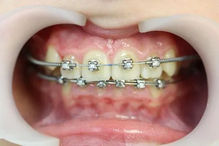 Cât timp ar trebui să poarte aparat dentar - termeni de corecție (acolade) Cât timp ar trebui să poarte aparat dentar - de corecție a temporizării