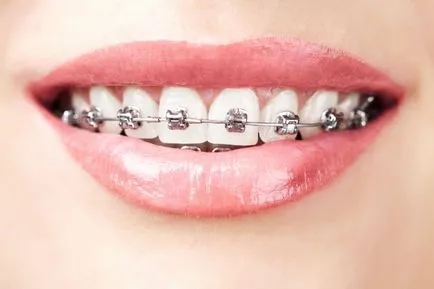 Cum de a purta aparat dentar pentru recomandarea pentru copii și adulți de viață - video - „toate detaliile“ Cum de a purta aparat dentar pentru recomandarea pentru copii și adulți de viață - video - „toate detaliile“