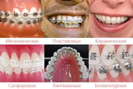Cât timp ar trebui să poarte bretele - bretele purtarea perioade (acolade) Cât timp ar trebui să poarte bretele - bretele poartă termene