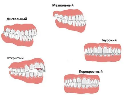 Cât timp ar trebui să poarte aparat dentar - corecție de temporizare (uzura) Cât timp ar trebui să poarte aparat dentar - de corecție a temporizării