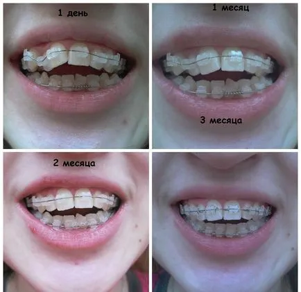 Cât timp ar trebui să poarte aparat dentar - termeni de corecție (acolade) Cât timp ar trebui să poarte aparat dentar - de corecție a temporizării