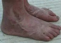 Vasculare simptome picioare, probleme