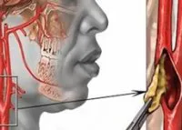 Vasculare simptome picioare, probleme