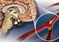 Vasculare simptome picioare, probleme