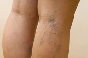 Simptomele picior vasculare, cauze, tratament