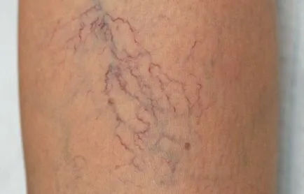 Boala vasculara picior - o revizuire a bolilor si simptomelor (vasculare) Boala vasculară picior - o revizuire a bolilor si simptomelor