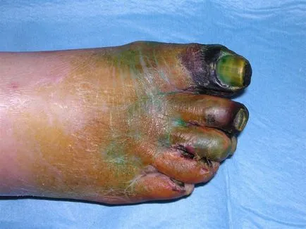 boli vasculare picioare, de ce rănit, care sunt simptomele, fotografie, tratamentul de tratament vascular