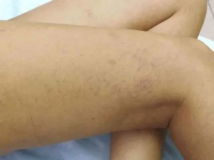 boli vasculare picioare, de ce rănit, care sunt simptomele, fotografie, tratamentul de tratament vascular