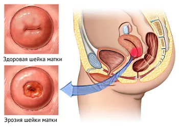 douching ginecologice