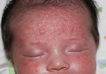 Staphylococcus aureus la sugari semnele leziunilor bacteriene
