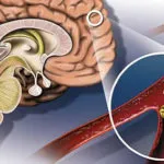 membrele inferioare droguri tratament vasoconstricție