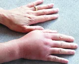 cheaguri de sânge în cauze ale corpului, simptomele, tratamentul (care este un cheag de sânge) cheaguri de sânge în cauzele corpului, simptome, tratament