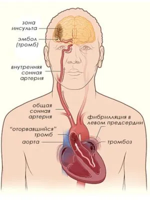 Tromboza, cheaguri de sânge, tromboză - prevenirea și tratamentul