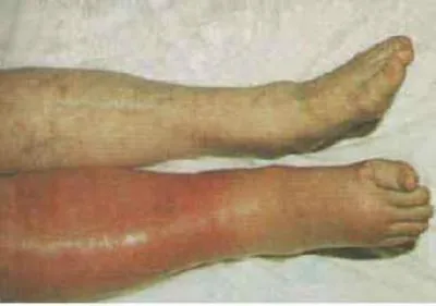 simptome Tromboza si cauze, diagnostic, tratament și consecințele (simptomele) simptome Tromboza si cauze, diagnostic, tratament și consecințe
