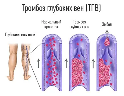 Tromboza tipurile, cauze, semne, simptome și tratament