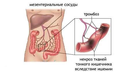 Tromboza tipurile, cauze, semne, simptome și tratament