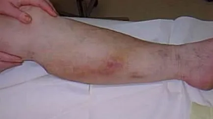 Tromboza, cheaguri de sânge, tromboză - prevenirea și tratamentul