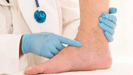 Vein simptome tromboză, semne, de la ceea ce se întâmplă și cum să trateze (semne) simptome tromboză venoasă, semne, de la ceea ce se întâmplă și cum să trateze