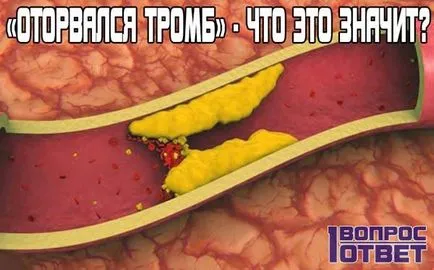 Cheagul a rupt că este ceea ce amenință să intre pe simptome cheaguri de sânge și efecte