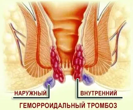 Tromboza tipurile, cauze, semne, simptome și tratament