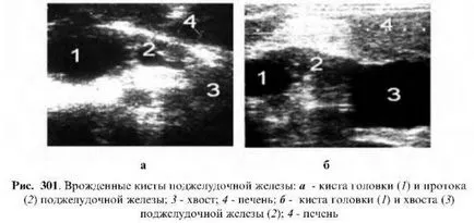 Examinarea cu ultrasunete a pancreasului (de cercetare) Examinarea cu ultrasunete a pancreasului