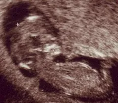 Ventriculomegalie fetale - cauze, tratament (fetus) Ventriculomegalie fătului - cauze, tratament