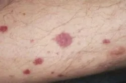 simptome vasculită, tratamentul de remedii populare la domiciliu (simptome) simptome vasculită, tratamentul de remedii populare la domiciliu