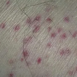 Simptomele vasculita și tratamentul bolii remedii populare Simptomele vasculita și tratamentul bolii remedii populare
