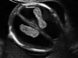 simptome Ventriculomegalie, tratament, descriere