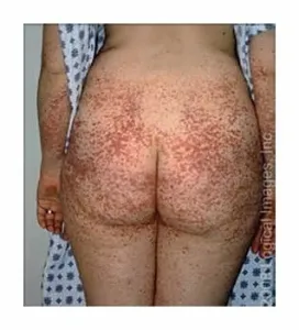 Vasculita - tratament, simptomele, cauzele