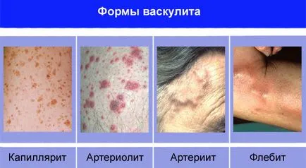 Vasculita ce fel de boală decât netratate, simptome, cauze