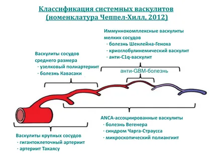Vasculita diagnostic, simptomele și tratamentul remedii populare (vasculita) Vasculita diagnostic, simptome și tratament de atac folk