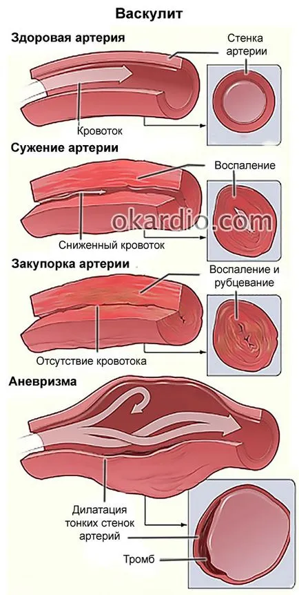 Vasculita ce fel de boală decât netratate, simptome, cauze