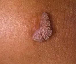 Human Papilloma Virus imagine, simptome și tratament