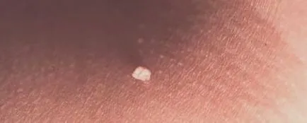Human Papilloma Virus imagine, simptome și tratament