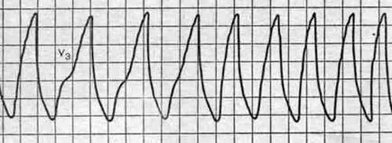 stop subita de cauza cardiaca cauze, simptome si tipuri de medicamente periculoase (brusc) stop subita de cauza cardiaca cauze, simptome si tipuri de medicamente periculoase