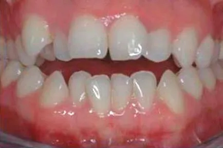 In timp ce poarta aparat dentar și de îngrijire a sistemului de suport (acolade) în timp ce purta aparat dentar și de îngrijire a sistemului de suport
